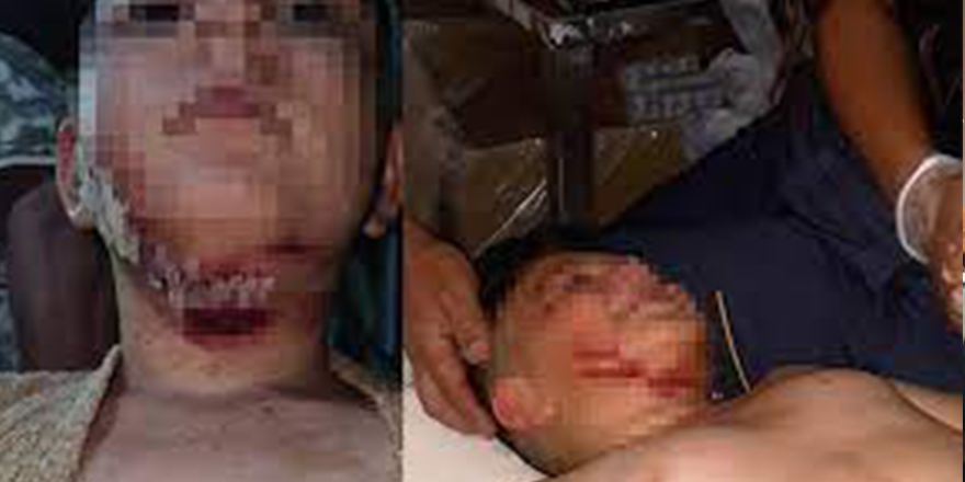 Konya'da sahipsiz köpeğin saldırdığı 9 yaşındaki çocuk yaralandı