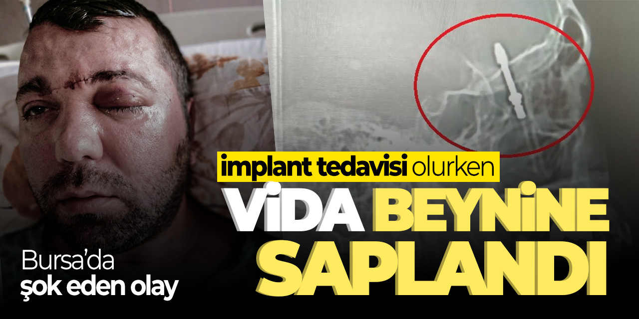 Bursa'da şok eden olay! İmplant tedavisi olurken beynine saplandı