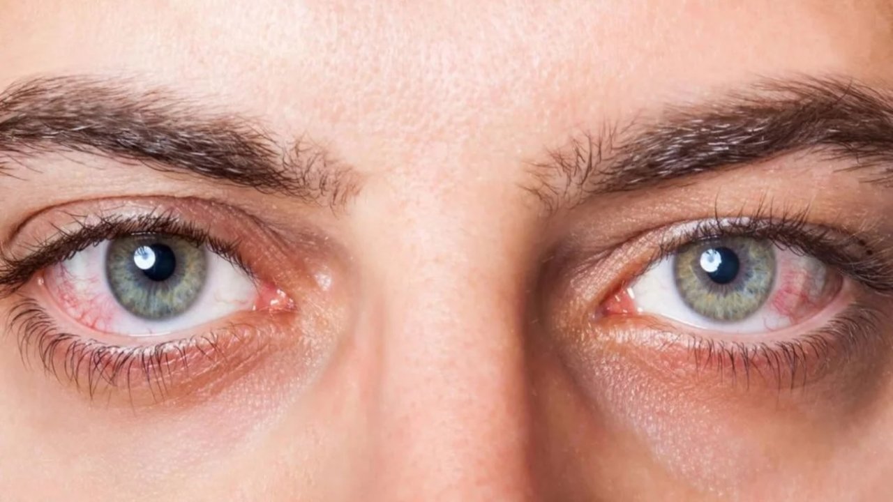 Göz Tansiyonu (Glokom) Hakkında Bilinmesi Gerekenler: Sessiz Görme Kaybına Dikkat!