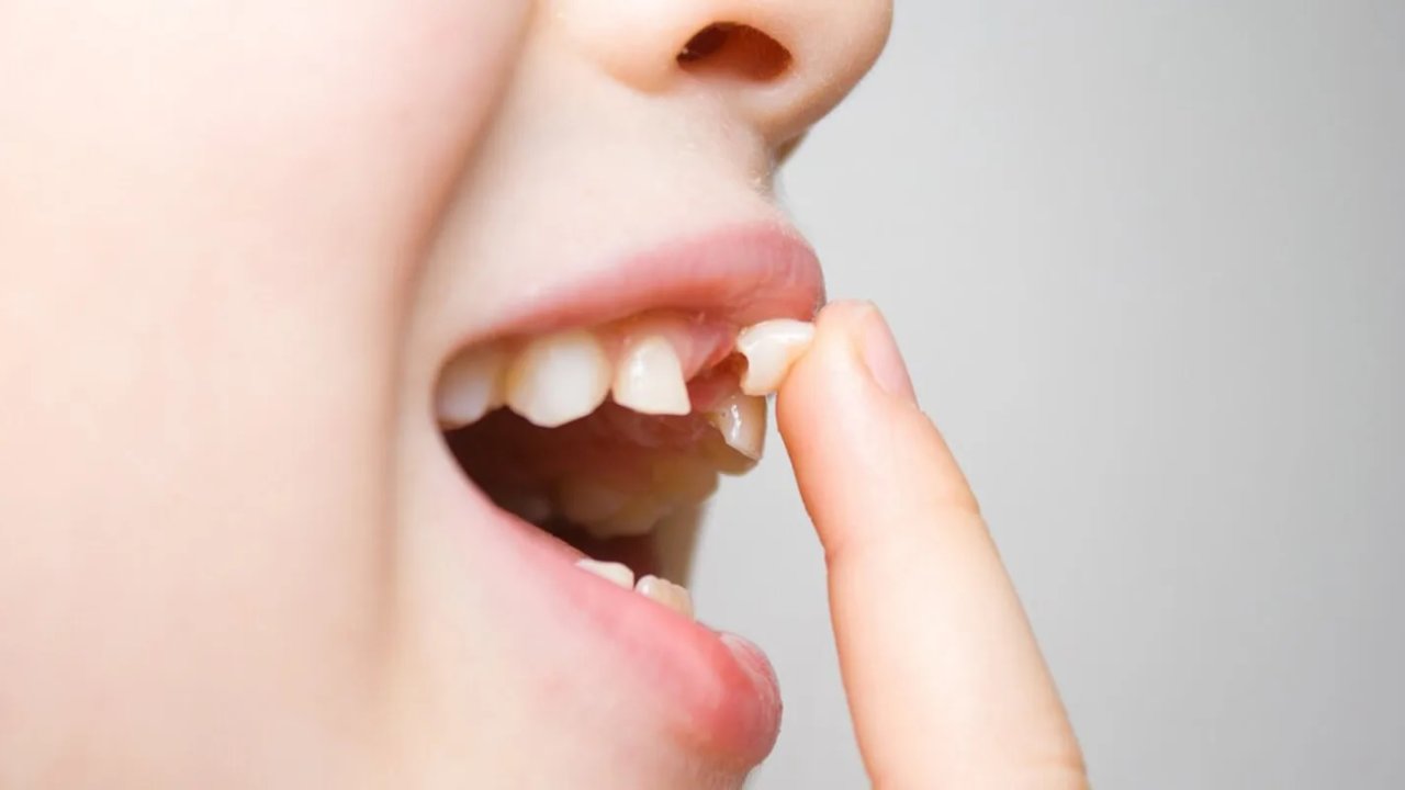 Çocuklarda 'Sallanan Diş Ergenliği' Nedir? Ebeveynler Bu Dönemi Nasıl Yönetmeli?