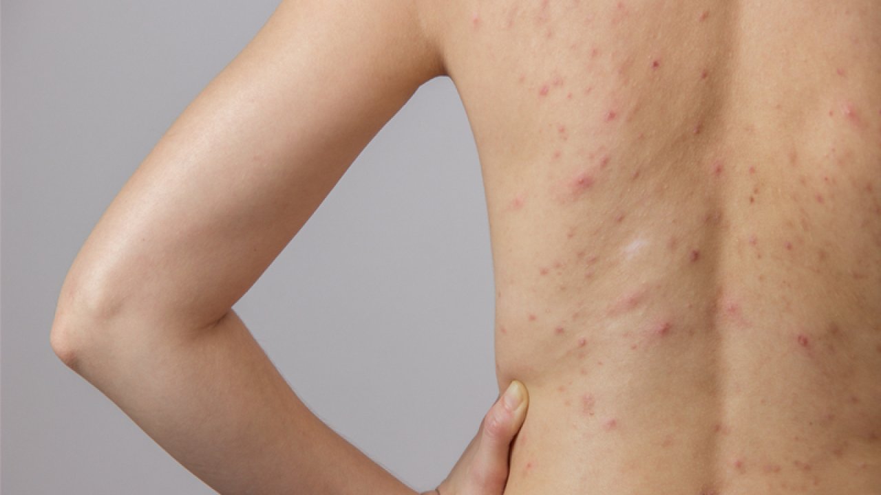 Derimizdeki mikroplar sağlığımız açısından nasıl bir rol oynuyor?