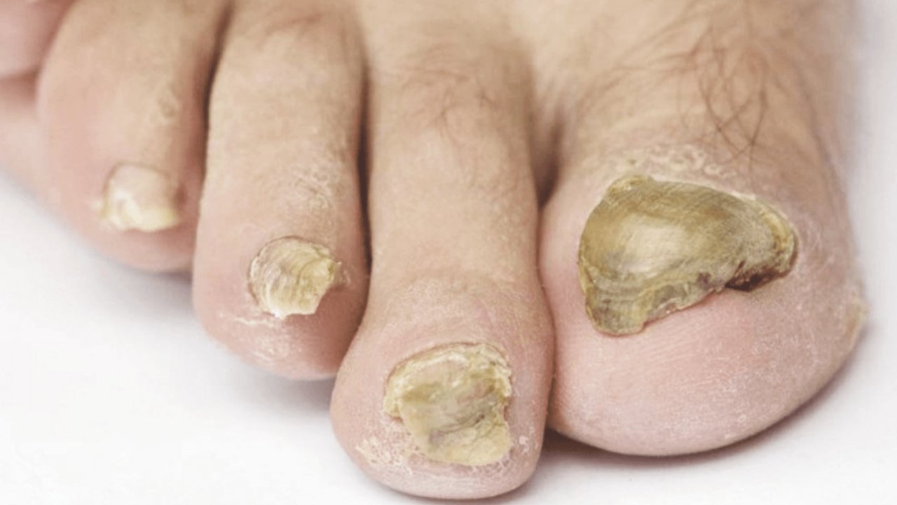 Tırnak mantarıyla mücadelede doğal yöntem: Sarımsağın gücü!