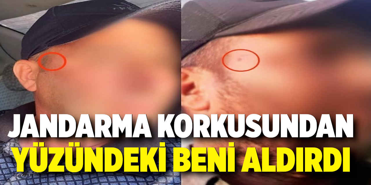 Jandarma Korkusundan Yüzündeki Beni Aldırdı