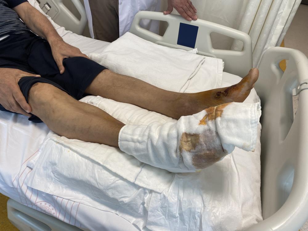 Leke sökücü kullanırken dikkat! Ayağından oluyordu